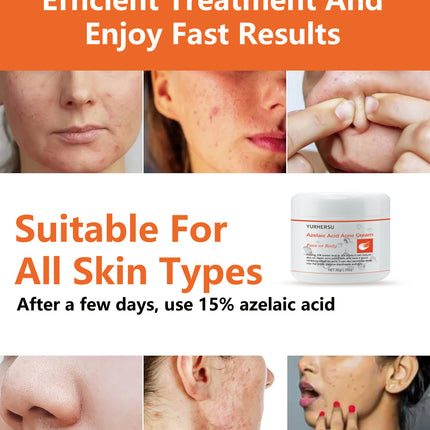 Anti-acne Smallpox Diluting Cream Oil Control Closed Mouth Men And Women