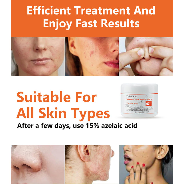 Anti-acne Smallpox Diluting Cream Oil Control Closed Mouth Men And Women