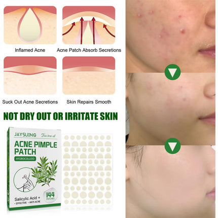 144 Patches Acne Pimple Patch Tea Tree Oil Serum Acne Treatment Pimple