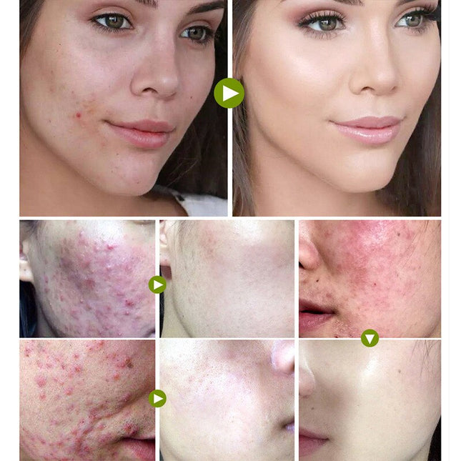Acne Removal Cream Treatment Pimples Acne Scar Shrink Pores Oil