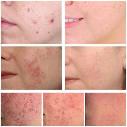 Acne Removal Cream Treatment Pimples Acne Scar Shrink Pores Oil
