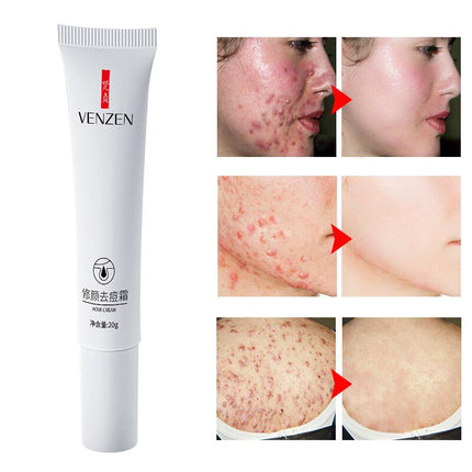 Acne Treatment Blackhead Remove Anti Acne Cream Oil Control Shrink