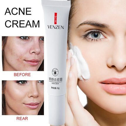 Acne Treatment Blackhead Remove Anti Acne Cream Oil Control Shrink