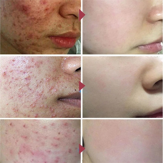 Herbal Acne Removal Face Cream Oil Control Anti-acne Gel Treatment